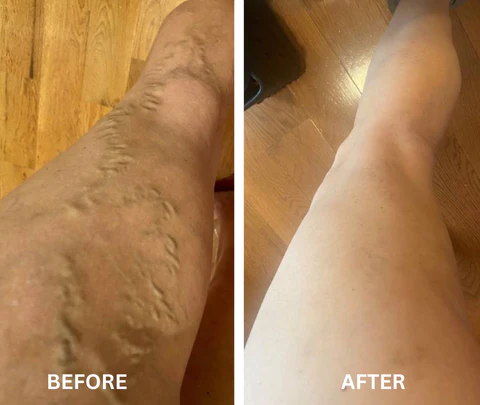 Raura™ Varicose Veins Treatment Spray