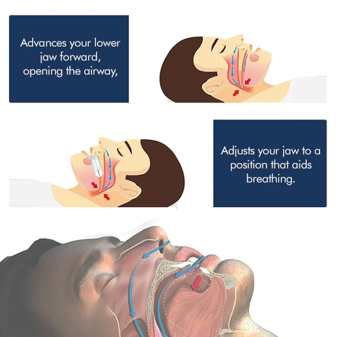 SleepZ™ Snore-free Mouth Piece