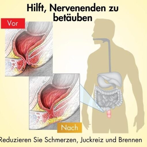 AEXZR™ Hämorrhoiden-Linderungscremewirksam