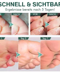 AEXZR™ Hühneraugenentfernung Extra Starkes Gel