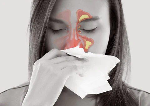 AEXZR™ Rhinitis Linderungsspray
