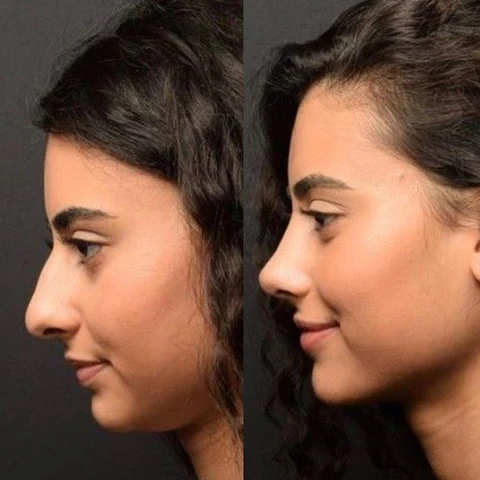 Biancat™ Magic Nose Shaper Device