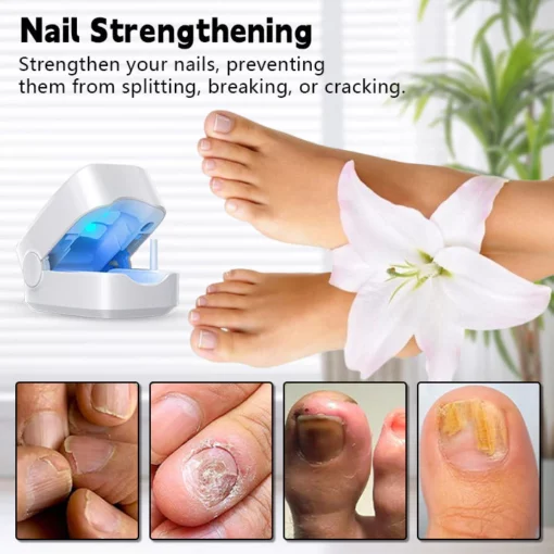 Biancat™ Nail Fungal Infection Repair Device