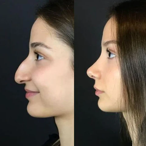 Fivfivgo™ Magic Nose Shaper Device