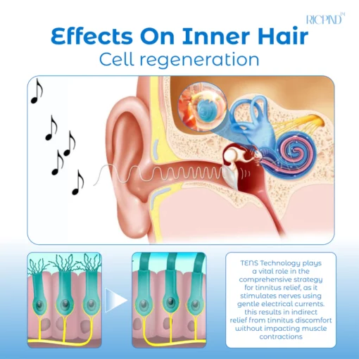 RICPIND Tinnitus NerveTreat InfraredThermal Pen