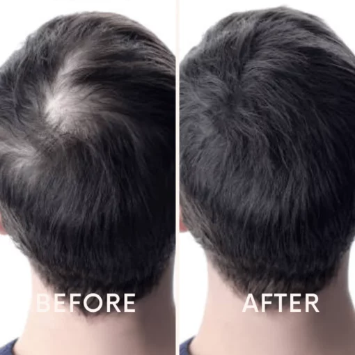 Seurico™ | Laser Cap for Hair Growth