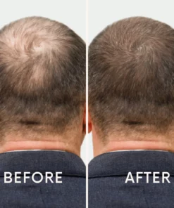 Seurico™ | Laser Cap for Hair Growth