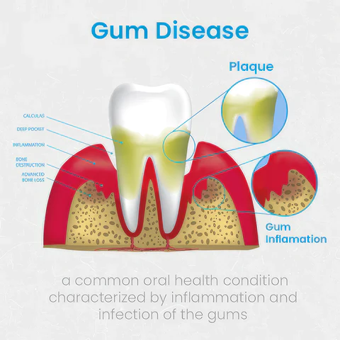 UNPREE™ Gum Shield Therapy Gel