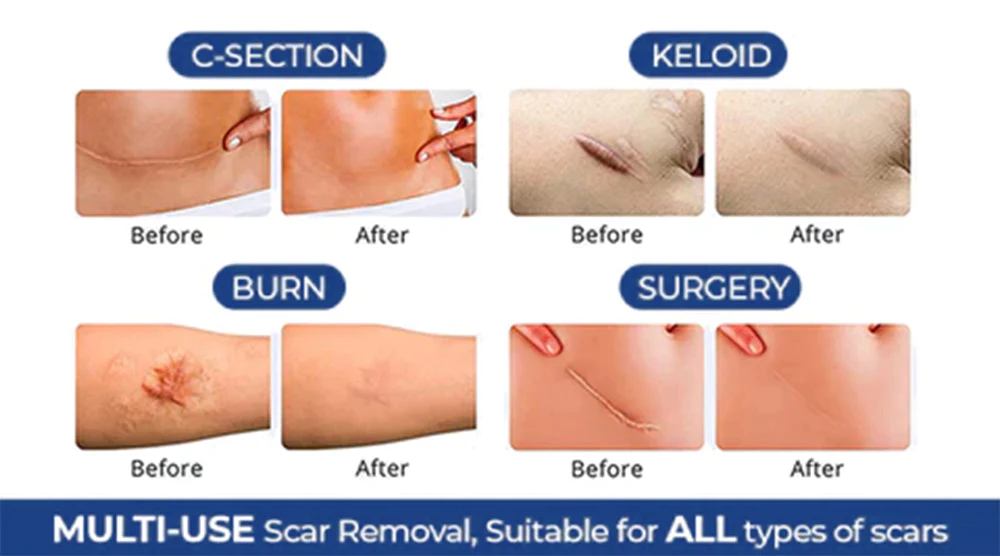 UNPREE™ Silicone Scar Removal Gel