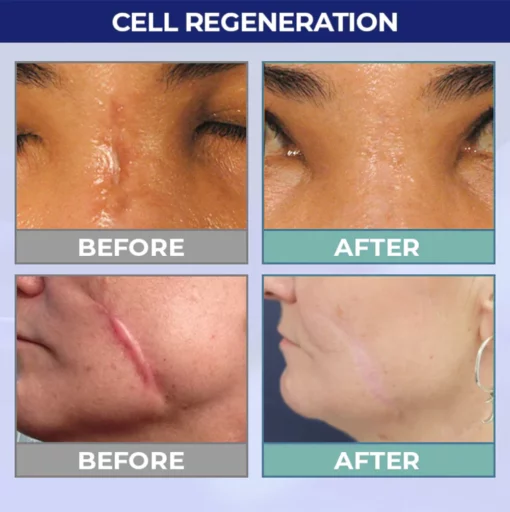 UNPREE™ Silicone Scar Removal Gel