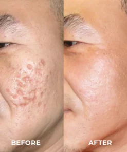 UNPREE™ Silicone Scar Removal Gel