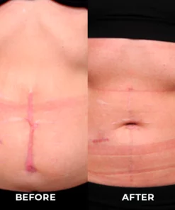 UNPREE™ Silicone Scar Removal Gel