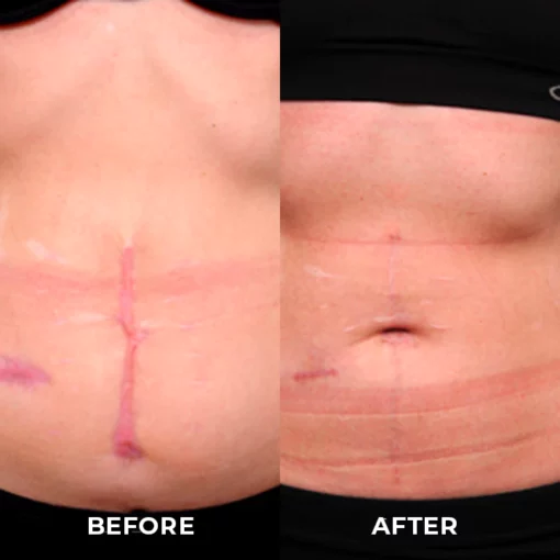 UNPREE™ Silicone Scar Removal Gel