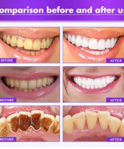 UNPREE™ Teeth Repairing Foam