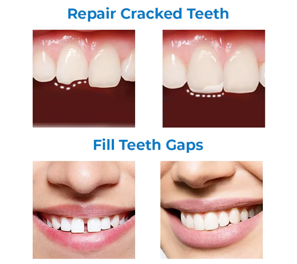 Unpree™ Temporary Moldable False Tooth
