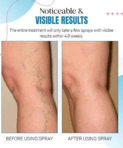 ZAKDAVI™ Varicose Veins Treatment Spray