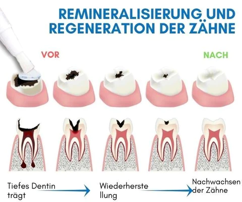 AEXZR™ Hai-Knorpelprotein-Zahnregenerationsgel