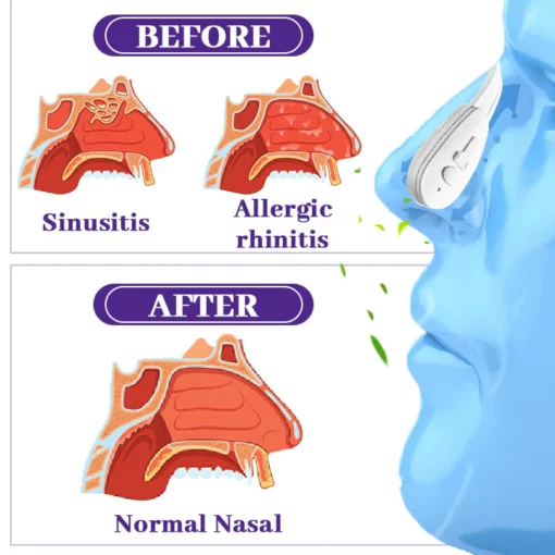 Biancat™ NasalEase Mucus Cleaning Device