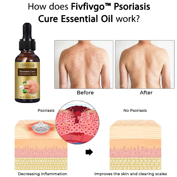 Fivfivgo™ Ätherisches Öl zur Psoriasis-Kur