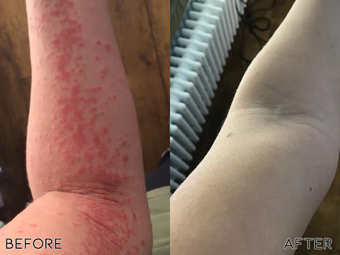 Fivfivgo™ Ätherisches Öl zur Psoriasis-Kur