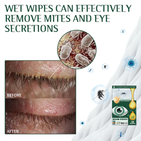 Fivfivgo™ Tea Tree Terpineol Eye Mite Removal Wipes