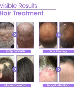 Oveallgo™ Hair Follicle Repair Hair Growth Drops - Achieve thicker hair quickly