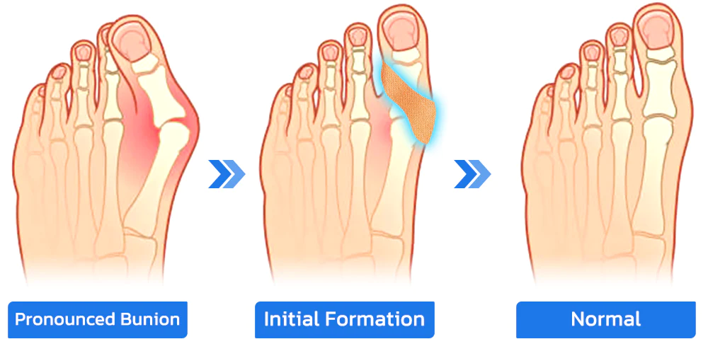 GFOUK™ ToebeJoin Correct Pression Patch