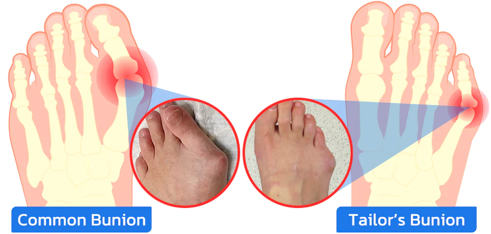 GFOUK™ ToebeJoin Correct Pression Patch