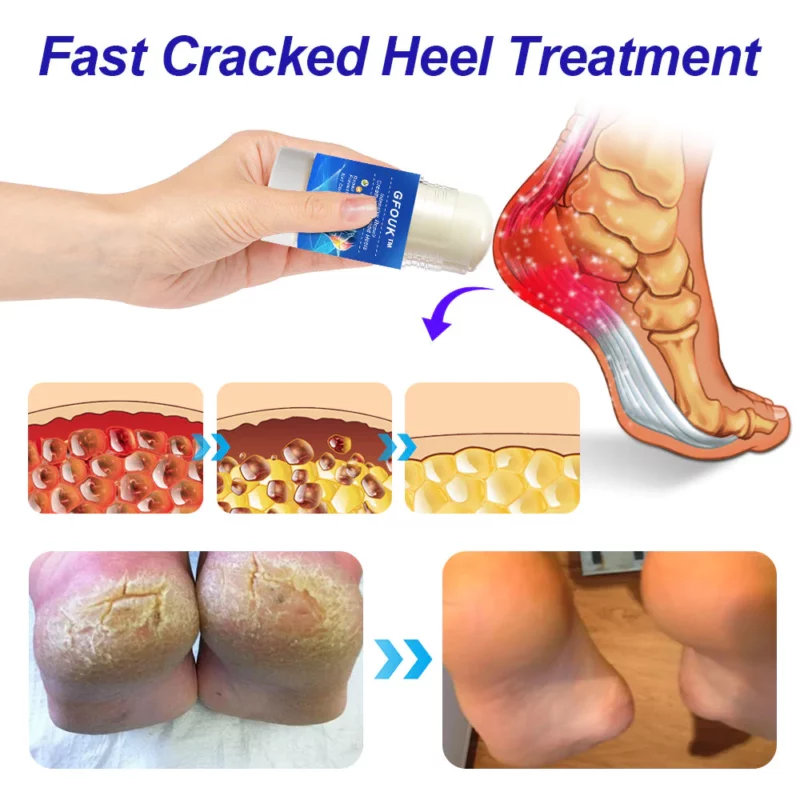 Repairing deals cracked heels