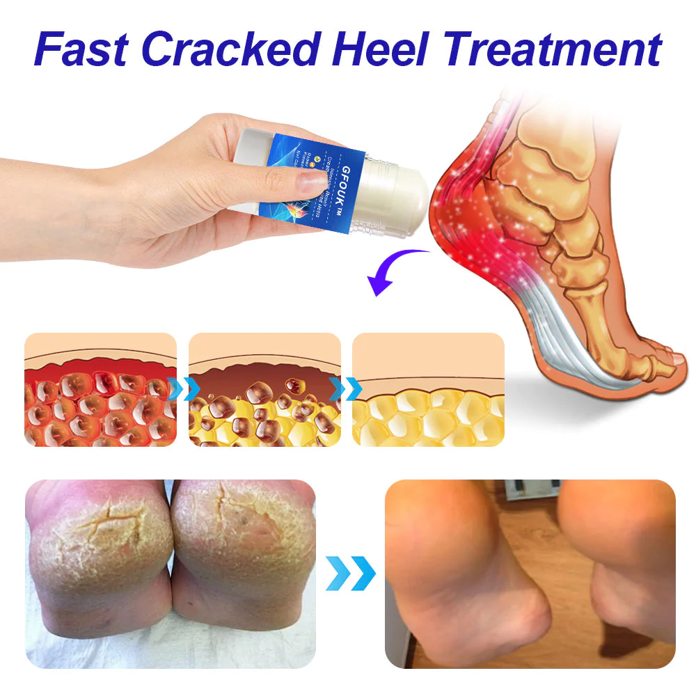 Healing cream for cracked on sale heels