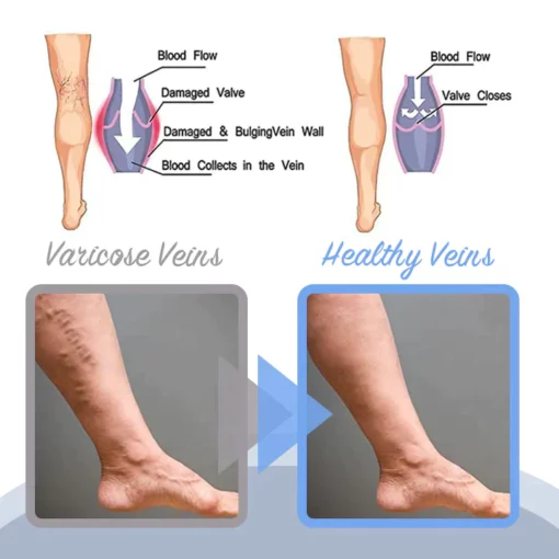 Lovild™ Varicose Veins Spray