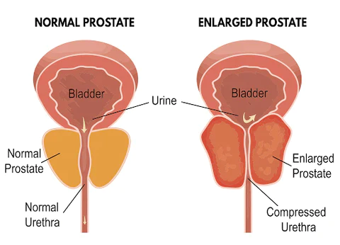 Prostaluxe™ Prostate atomizing