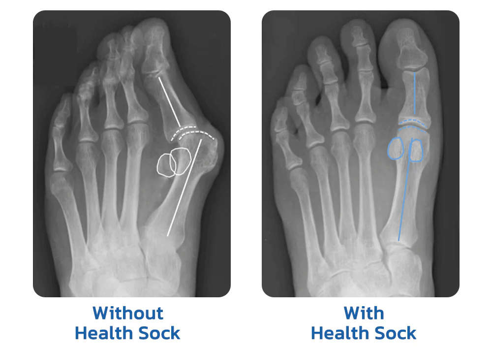 SUPTRUCK™ Orthopedic Bunion Relief Socks