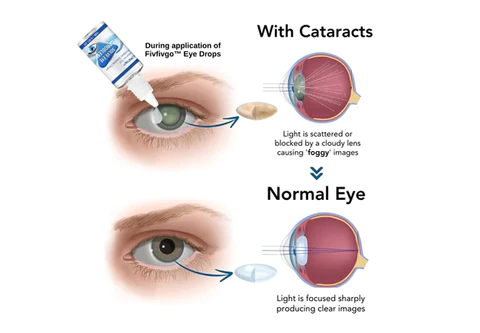 LIMETOW™ Myopia Reversal Eye Drops