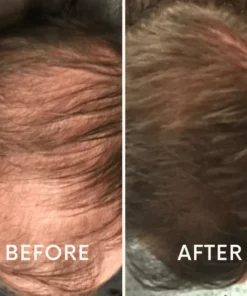 Oveallgo ™ Mobile Laser Therapy Cap for Hair Regrowth