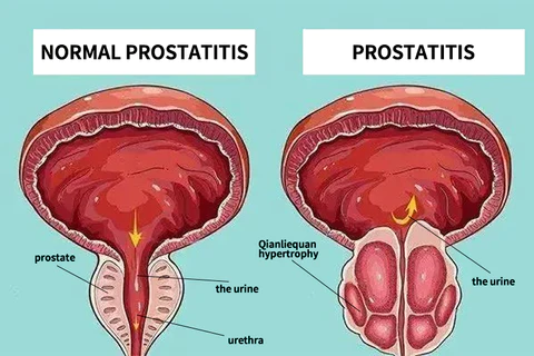 ProVig™ Exclusive Patented Prostate Health Spray - Clinically Proven Effective