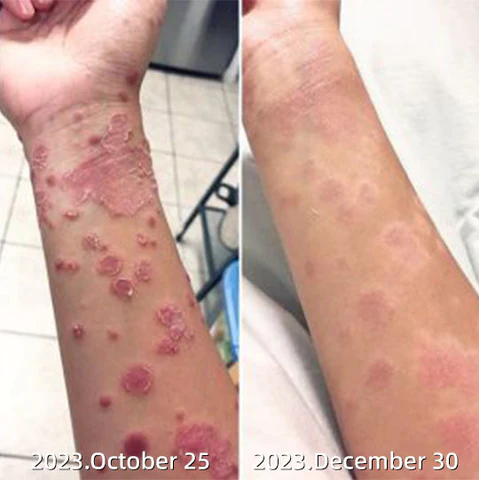 Seurico™ Psoriasis Treatment Spray