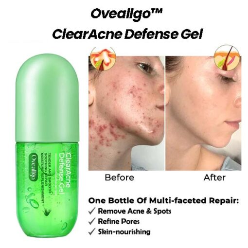 ZitZap™ Exclusive Patent Acne Skin Repair Expert-Cleansing and Acne