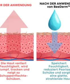 BeeDerm™ Bienengift Psoriasis Behandlungscreme