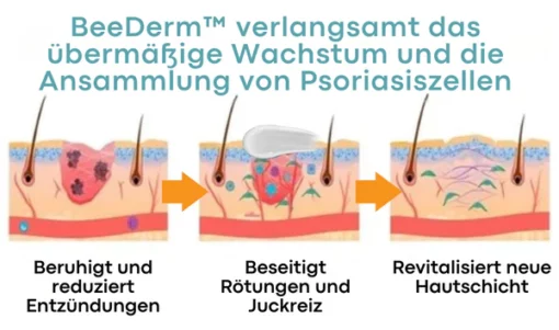 BeeDerm™ Bienengift Psoriasis Behandlungscreme