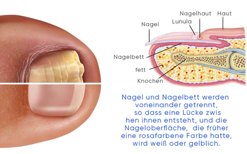 Biancat™ OnyxoGuard Nagelwachstums- und Reparaturs Serum