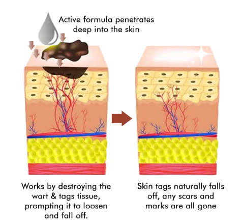 Furzero™ Bee Venom Wart and Tags Removal Treatment Spray