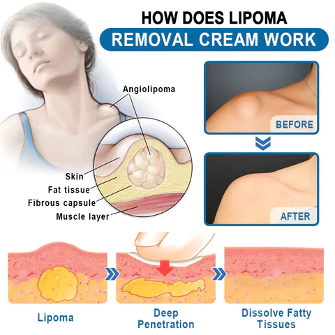 KISSHI™ Lipoma Removal Cream
