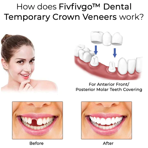 Oveallgo™ Dental Temporary Crown Veneers