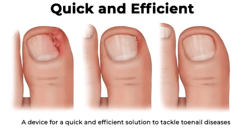 Oveallgo™ Light Therapy Device For Toenail Diseases
