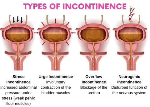 Bladder Control Patch 