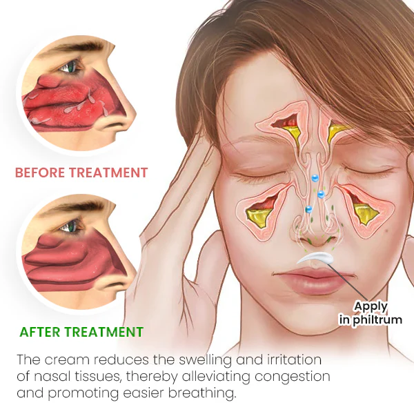 BreathLux™ Rhinitis Relief Cream