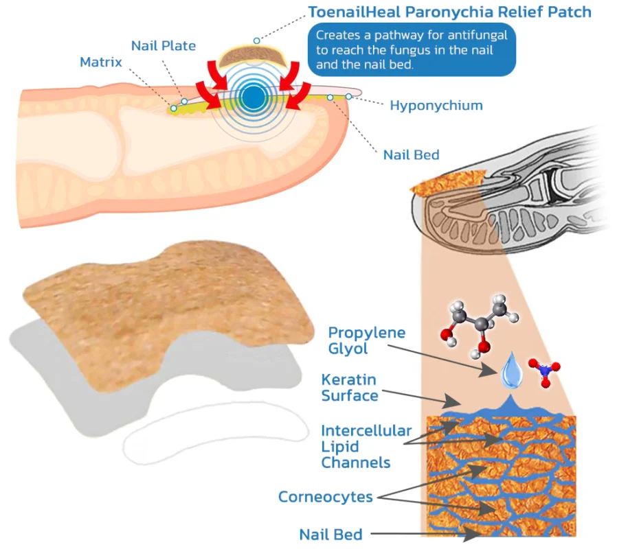 GFOUK™ German ToenailHeal Paronychia Relief Patch