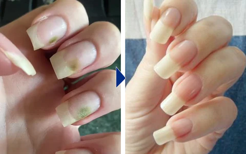 LIMETOW™ OnyxoGuard Nail Growth and Repair Serum