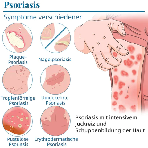 Ourlyard™ Multi-Symptom Psoriasis-Behandlungscreme